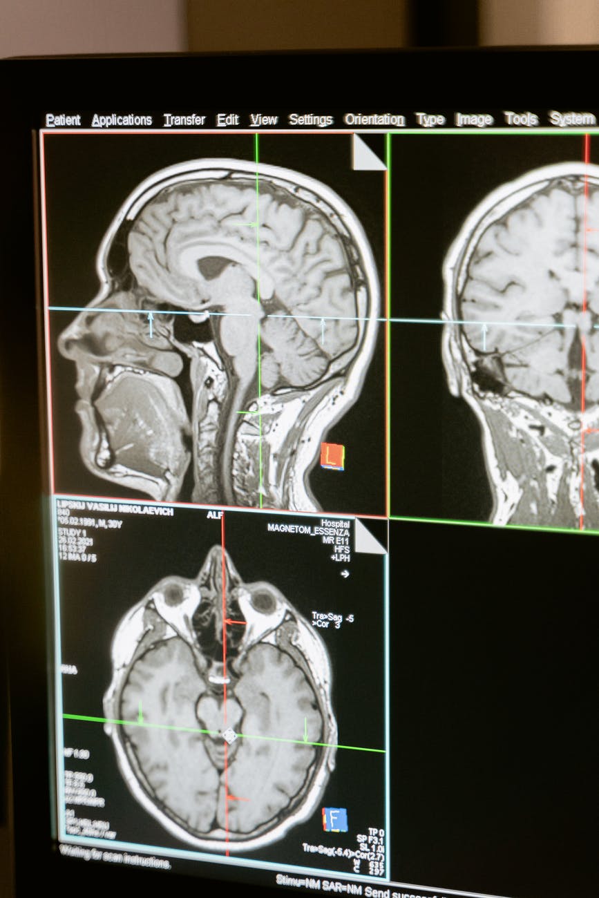 Diagnosis and Treatment of Brain and Neck Vessels in Switzerland