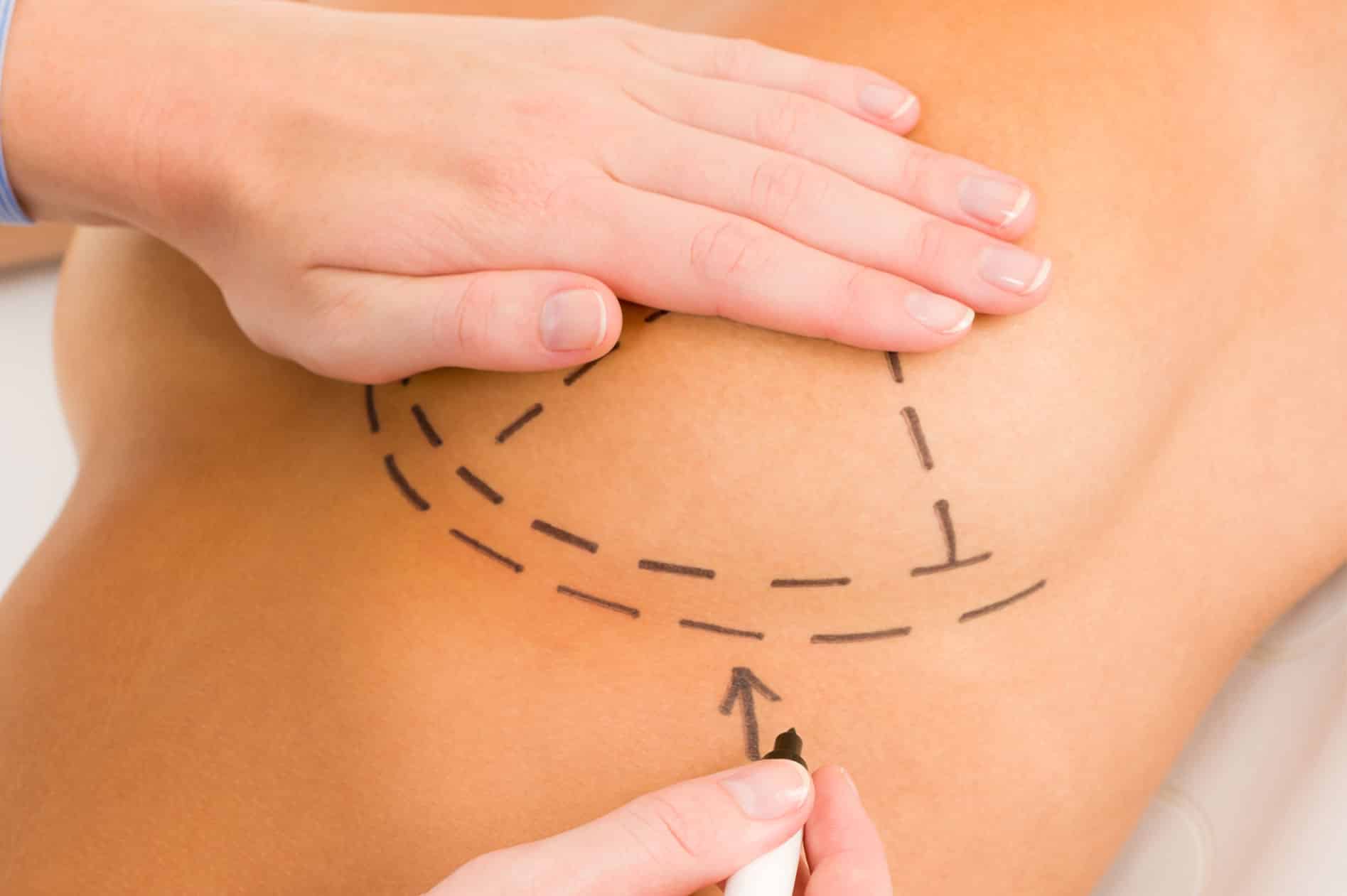 The 5 Most Popular Plastic Surgery Procedures of the Year